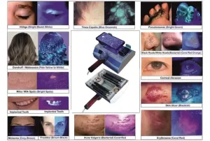 Woods Lamp for Skin Analyzer with Mobile & Remote attachment